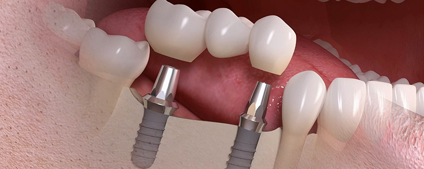 services 03 top emfyteumata dontiwn
